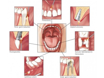 Лазер стоматологический